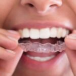 Placas de Clareamento: O que são, como funcionam e cuidados essenciais